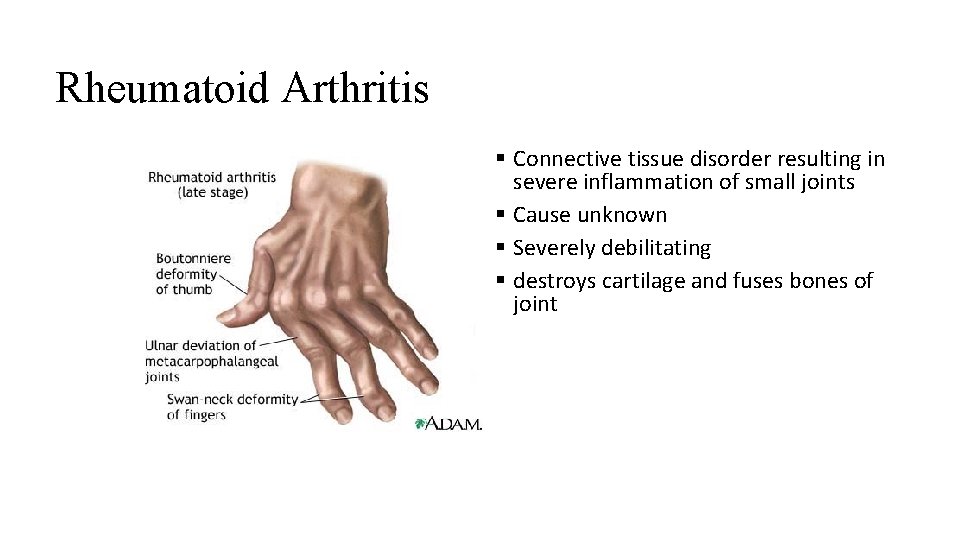 Rheumatoid Arthritis § Connective tissue disorder resulting in severe inflammation of small joints §