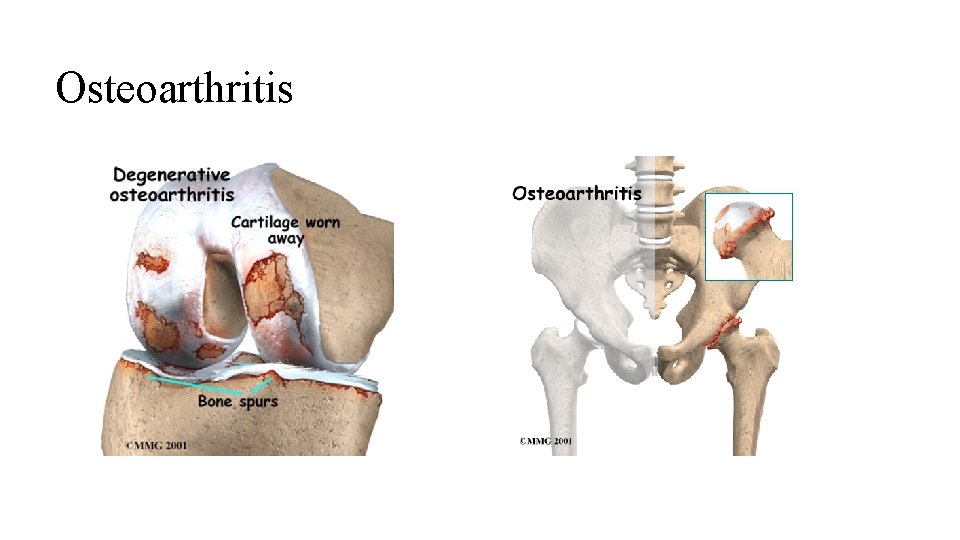 Osteoarthritis 