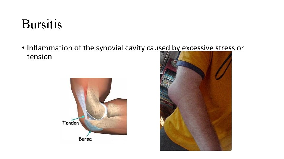 Bursitis • Inflammation of the synovial cavity caused by excessive stress or tension 