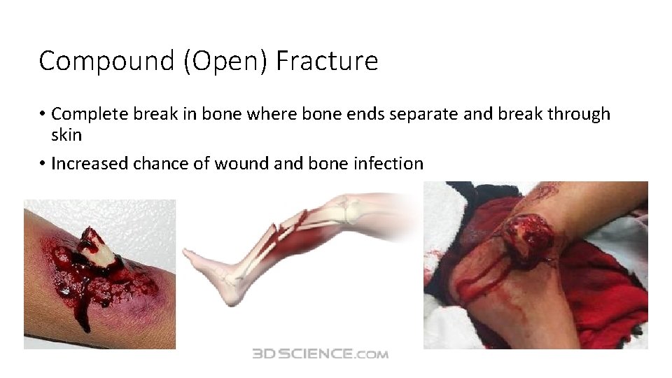 Compound (Open) Fracture • Complete break in bone where bone ends separate and break