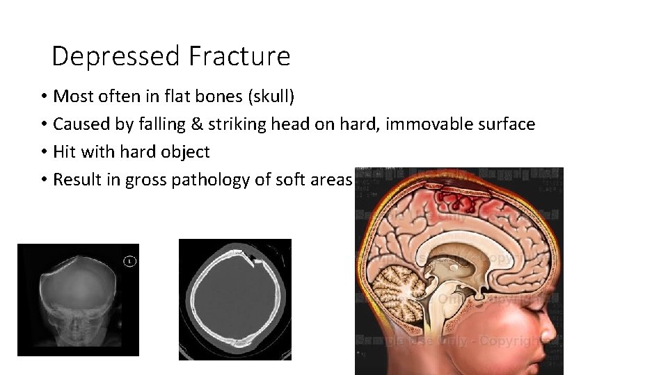 Depressed Fracture • Most often in flat bones (skull) • Caused by falling &