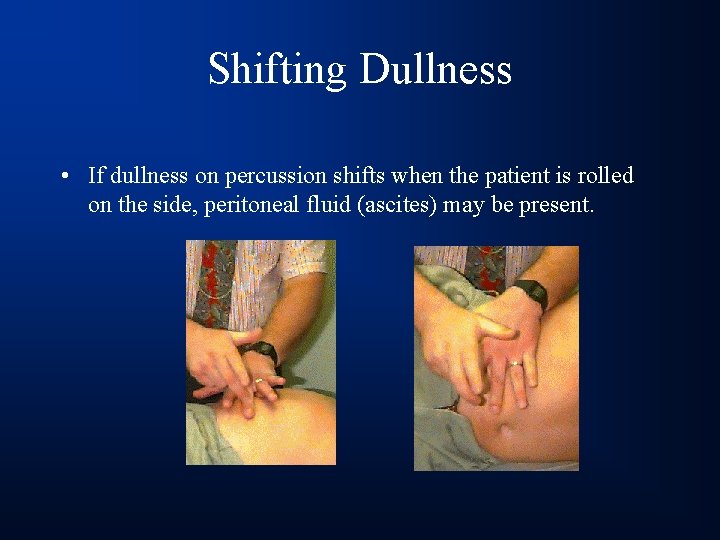 Shifting Dullness • If dullness on percussion shifts when the patient is rolled on