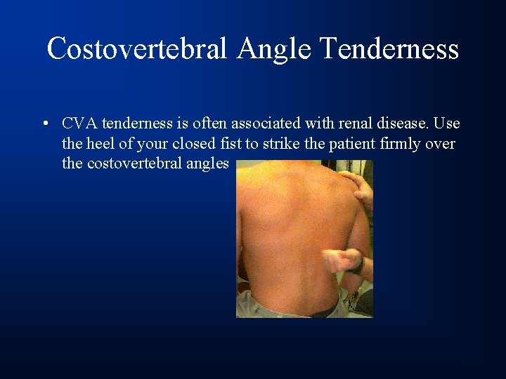 Costovertebral Angle Tenderness • CVA tenderness is often associated with renal disease. Use the