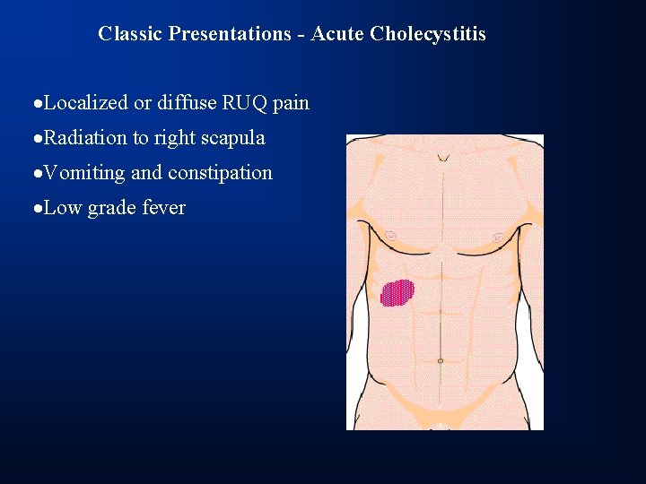 Classic Presentations - Acute Cholecystitis ·Localized or diffuse RUQ pain ·Radiation to right scapula