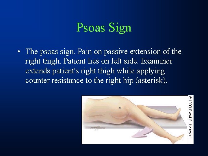 Psoas Sign • The psoas sign. Pain on passive extension of the right thigh.