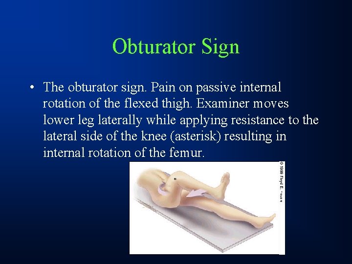 Obturator Sign • The obturator sign. Pain on passive internal rotation of the flexed