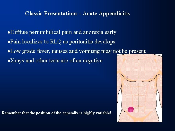 Classic Presentations - Acute Appendicitis ·Diffuse periumbilical pain and anorexia early ·Pain localizes to