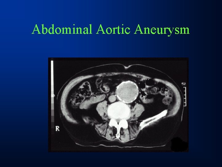 Abdominal Aortic Aneurysm 