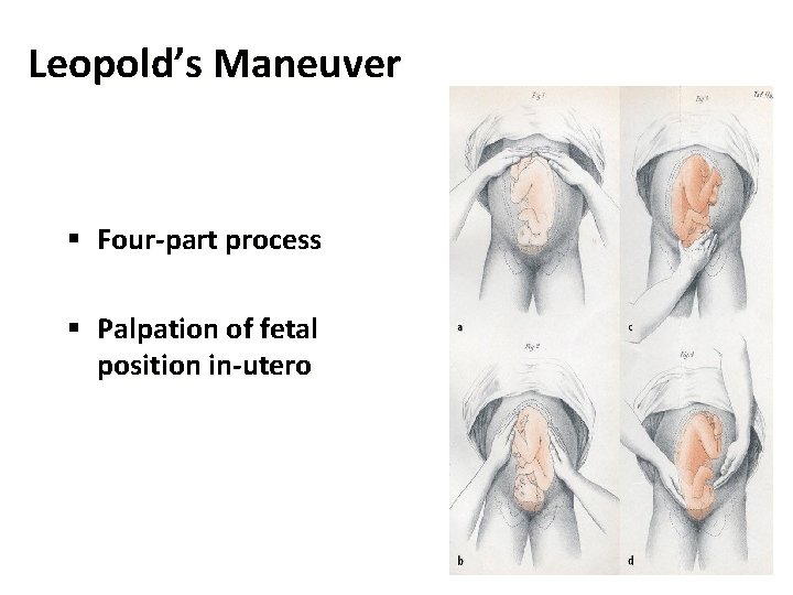 Leopold’s Maneuver § Four-part process § Palpation of fetal position in-utero 