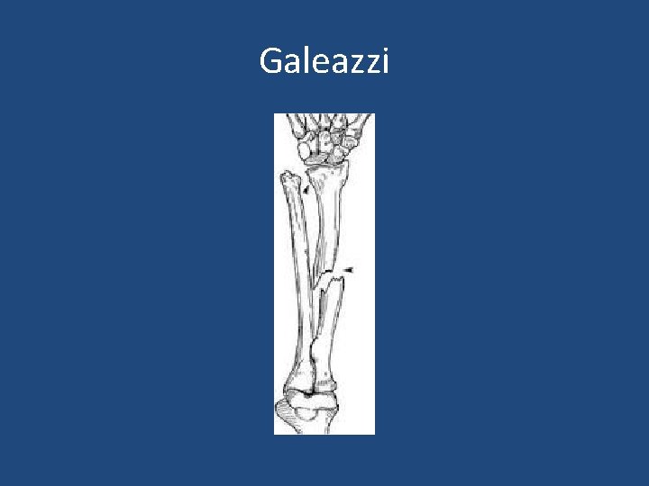 Galeazzi 