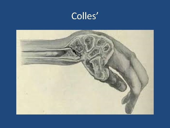 Colles’ 