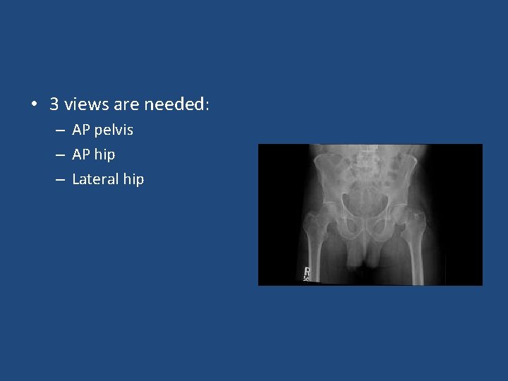 • 3 views are needed: – AP pelvis – AP hip – Lateral