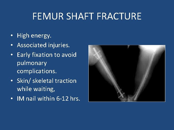 FEMUR SHAFT FRACTURE • High energy. • Associated injuries. • Early fixation to avoid