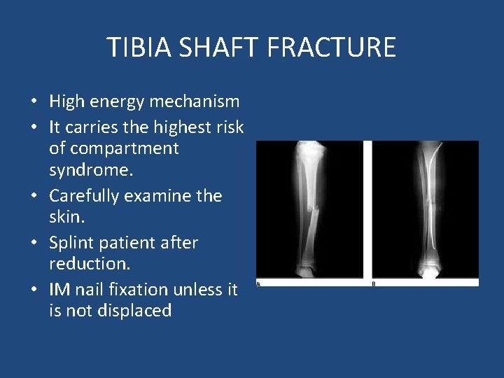 TIBIA SHAFT FRACTURE • High energy mechanism • It carries the highest risk of
