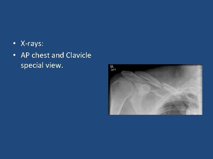  • X-rays: • AP chest and Clavicle special view. 