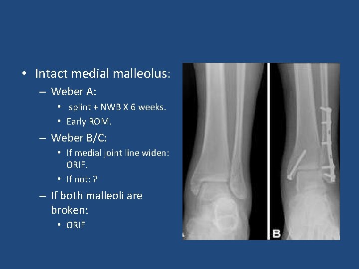  • Intact medial malleolus: – Weber A: • splint + NWB X 6