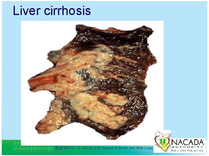 Liver cirrhosis 