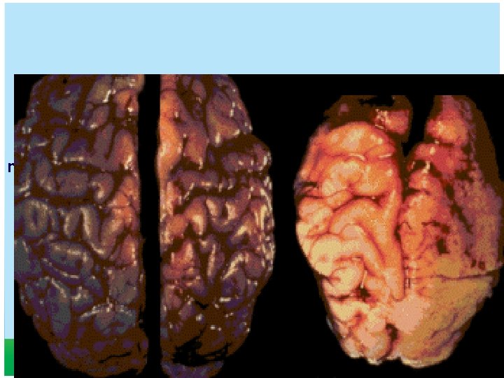 Brain of baby with no exposure to alcohol Brain of baby with heavy prenatal