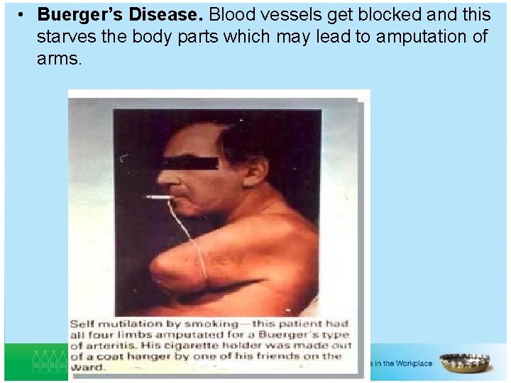  • Buerger’s Disease. Blood vessels get blocked and this starves the body parts