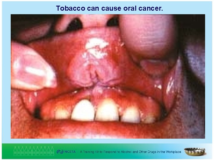 Tobacco can cause oral cancer. 