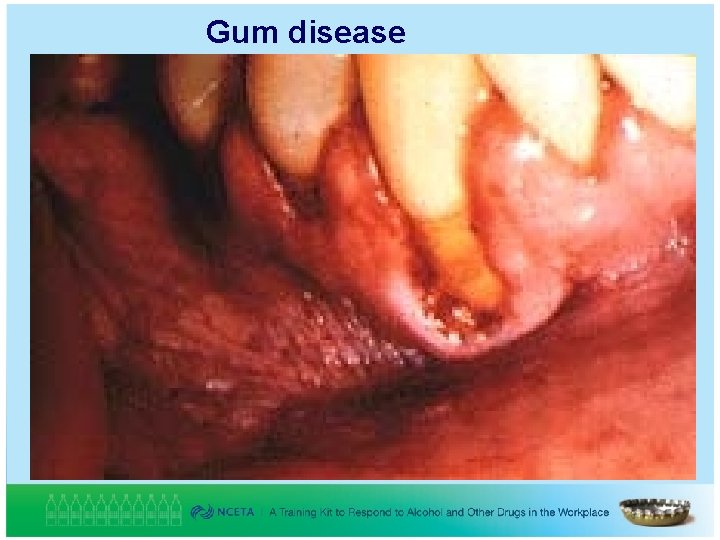 Gum disease 