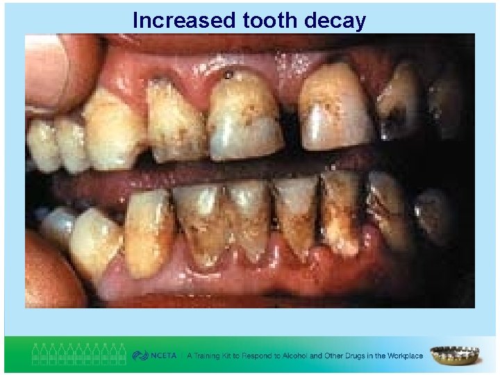 Increased tooth decay 