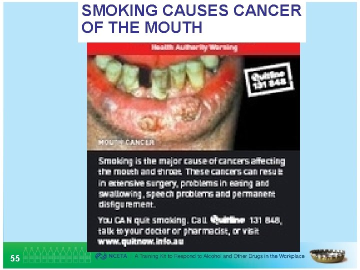 SMOKING CAUSES CANCER OF THE MOUTH 55 