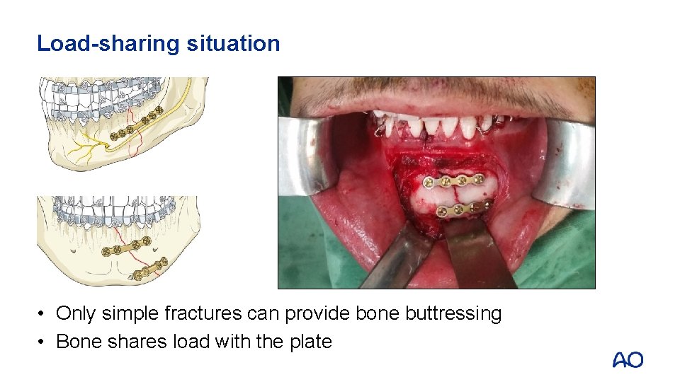 Load-sharing situation • Only simple fractures can provide bone buttressing • Bone shares load
