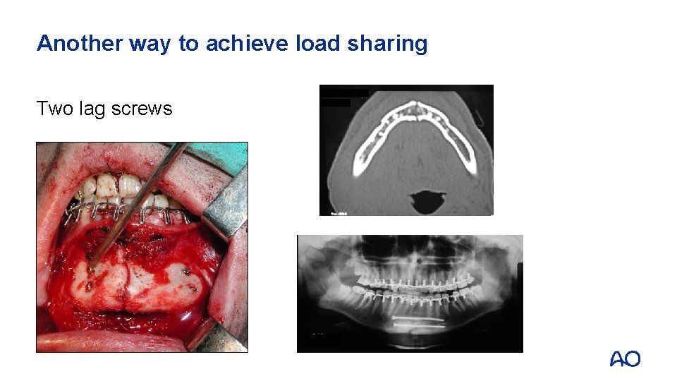 Another way to achieve load sharing Two lag screws 