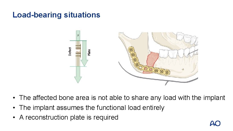 Load-bearing situations • The affected bone area is not able to share any load