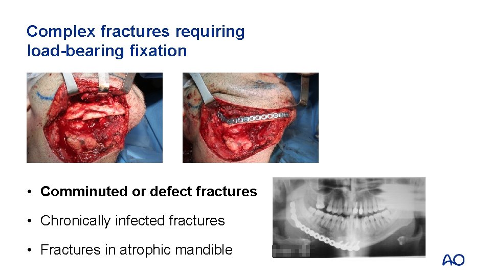 Complex fractures requiring load-bearing fixation • Comminuted or defect fractures • Chronically infected fractures