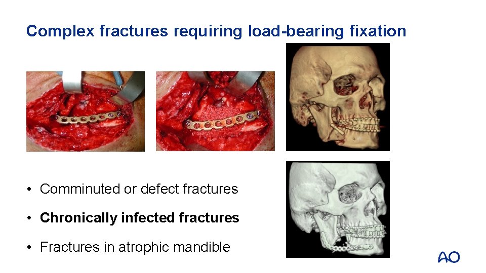 Complex fractures requiring load-bearing fixation • Comminuted or defect fractures • Chronically infected fractures