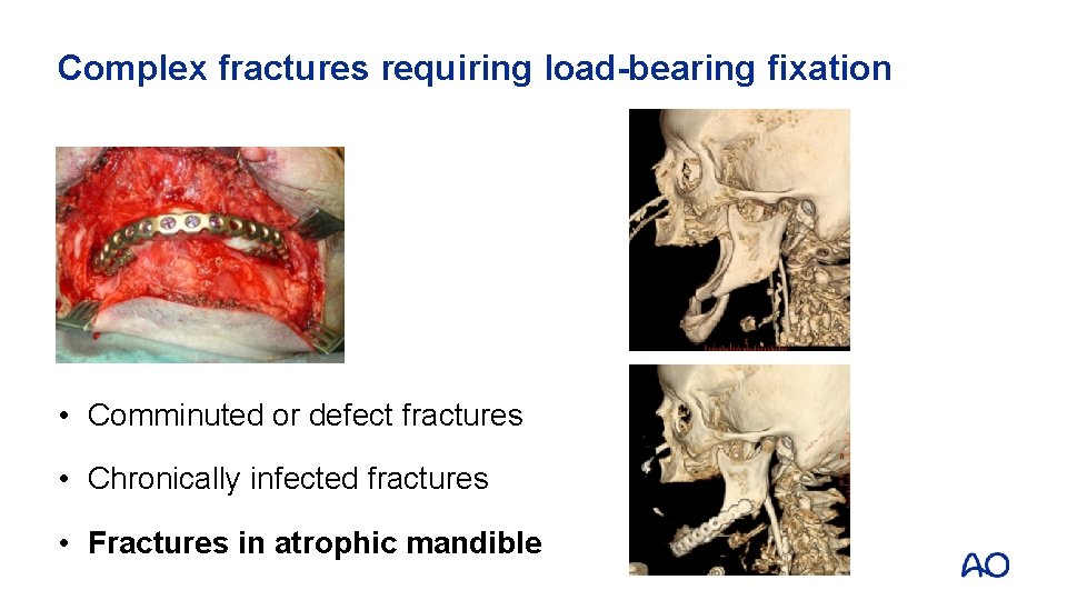 Complex fractures requiring load-bearing fixation • Comminuted or defect fractures • Chronically infected fractures