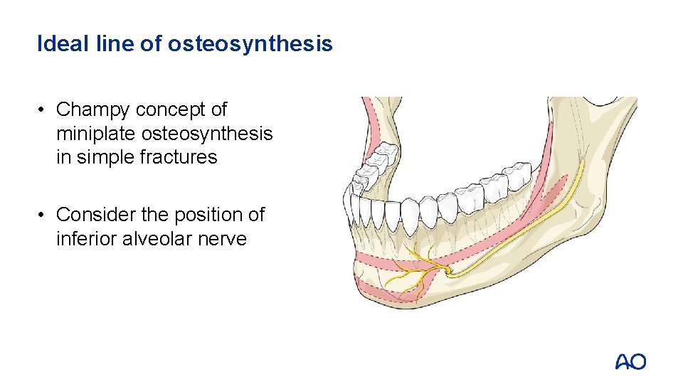 Ideal line of osteosynthesis • Champy concept of miniplate osteosynthesis in simple fractures •
