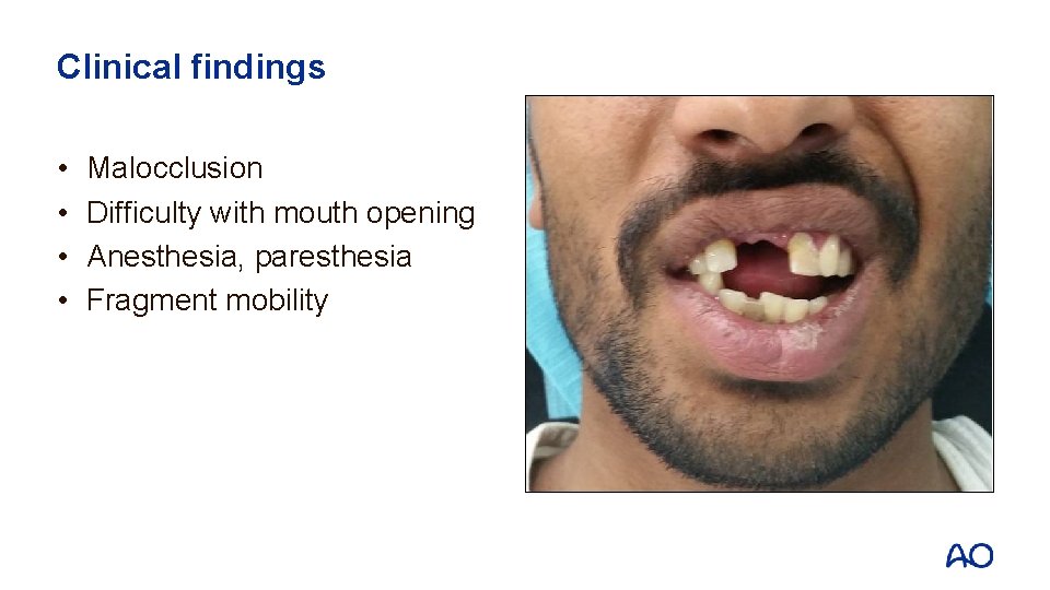 Clinical findings • • Malocclusion Difficulty with mouth opening Anesthesia, paresthesia Fragment mobility 