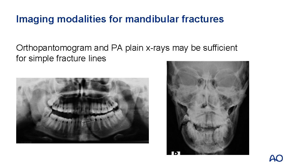 Imaging modalities for mandibular fractures Orthopantomogram and PA plain x-rays may be sufficient for