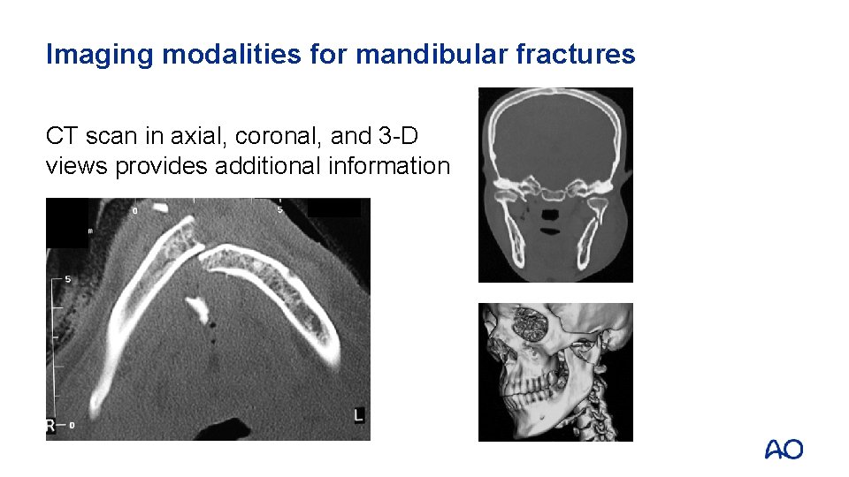 Imaging modalities for mandibular fractures CT scan in axial, coronal, and 3 -D views