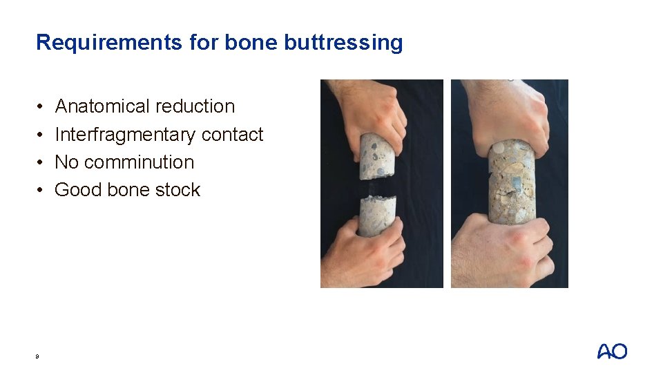 Requirements for bone buttressing • • 9 Anatomical reduction Interfragmentary contact No comminution Good