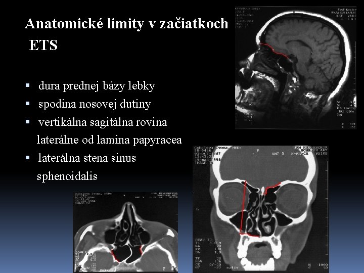 Anatomické limity v začiatkoch ETS dura prednej bázy lebky spodina nosovej dutiny vertikálna sagitálna