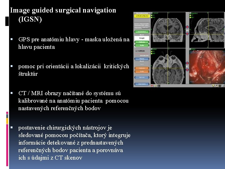 Image guided surgical navigation (IGSN) GPS pre anatómiu hlavy - maska uložená na hlavu