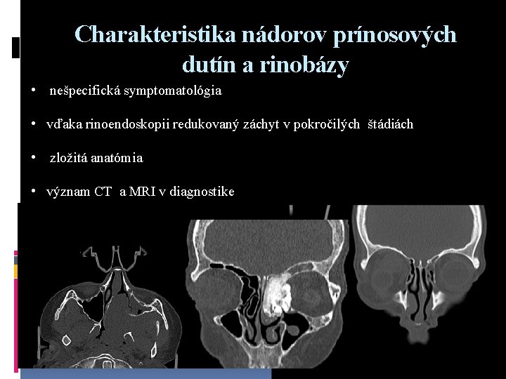 Charakteristika nádorov prínosových dutín a rinobázy • nešpecifická symptomatológia • vďaka rinoendoskopii redukovaný záchyt