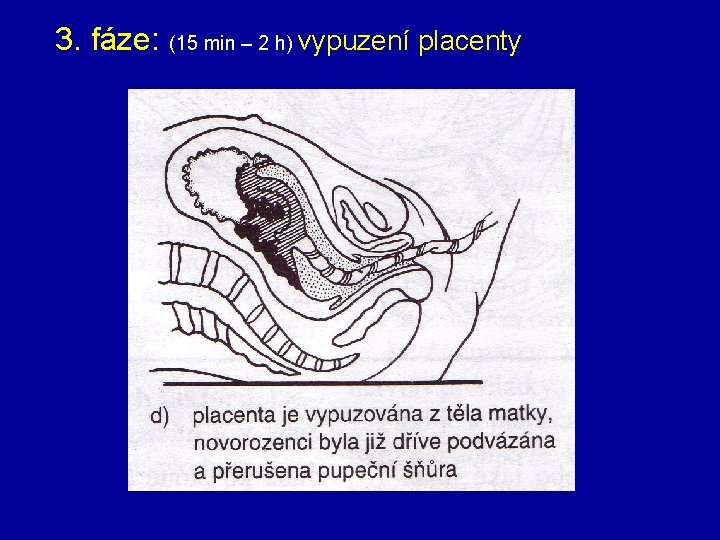 3. fáze: (15 min – 2 h) vypuzení placenty 