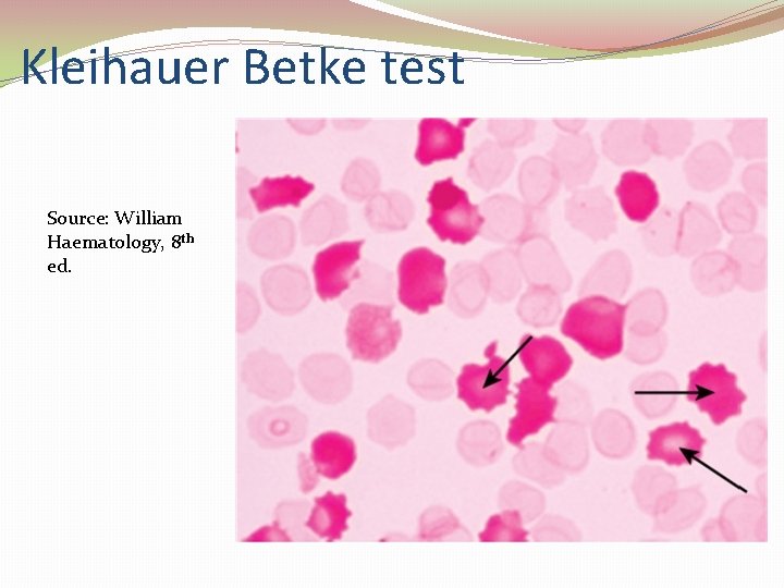 Kleihauer Betke test Source: William Haematology, 8 th ed. 