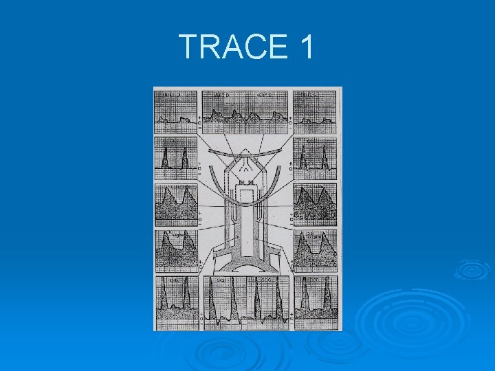 TRACE 1 