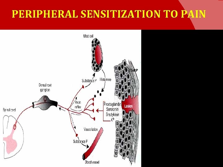 PERIPHERAL SENSITIZATION TO PAIN CGRP 