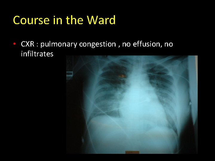 Course in the Ward • CXR : pulmonary congestion , no effusion, no infiltrates