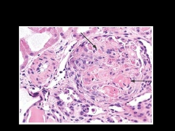 Hyaline thrombi in the lumen of glomerular capillary loops (arrows). 