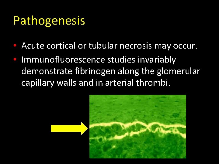 Pathogenesis • Acute cortical or tubular necrosis may occur. • Immunofluorescence studies invariably demonstrate