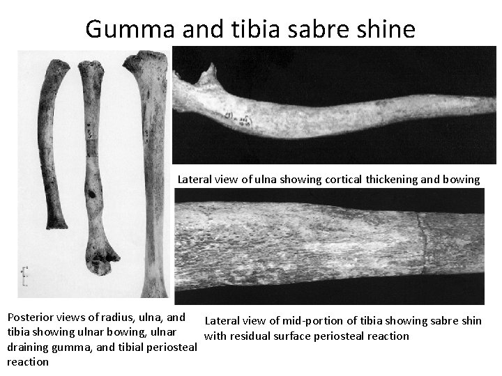 Gumma and tibia sabre shine Lateral view of ulna showing cortical thickening and bowing