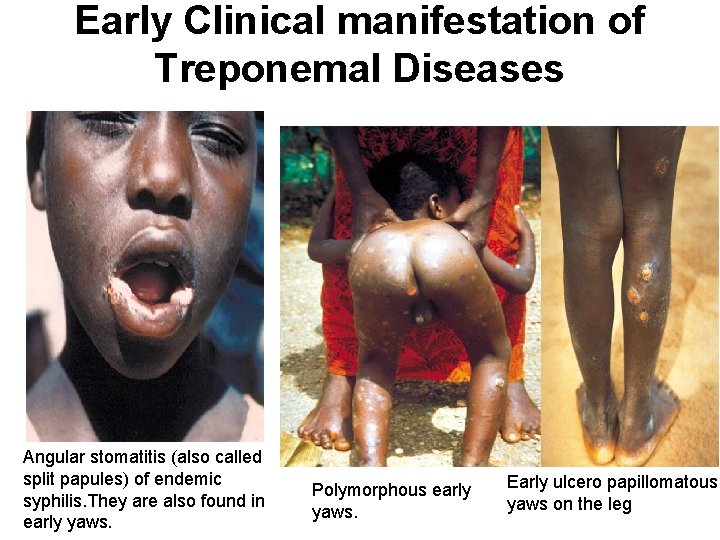Early Clinical manifestation of Treponemal Diseases Angular stomatitis (also called split papules) of endemic